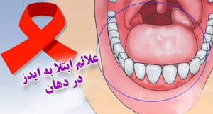 hhh1194 نشانه های ابتلا به ایدز در دهان